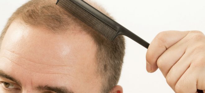 What to Expect When Undergoing an FUE Hair Transplant in New York City