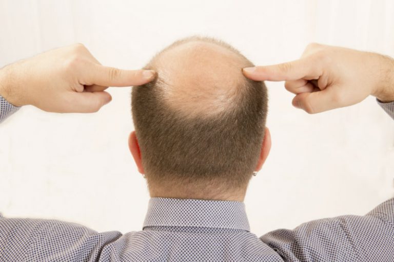 The Benefits of Getting a Hair Transplant in Pompano Beach, FL