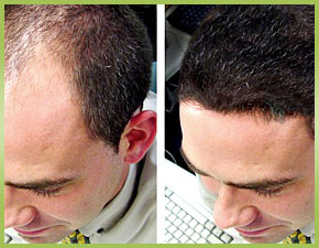 FUE Hair Transplants in NYC: Expert Solutions for Hair Restoration