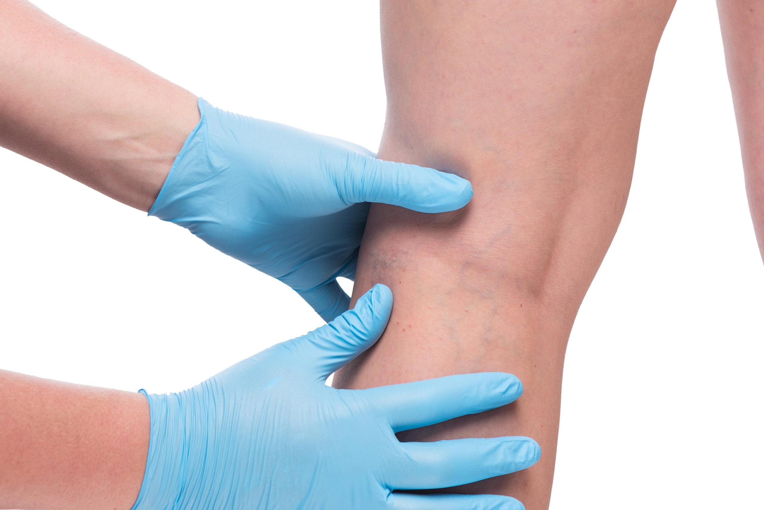 Finding Relief with Vein Treatment in Pennsylvania