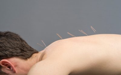 Experience Natural Relief With Acupuncture For Stress in Bellingham, WA Local Residents Trust